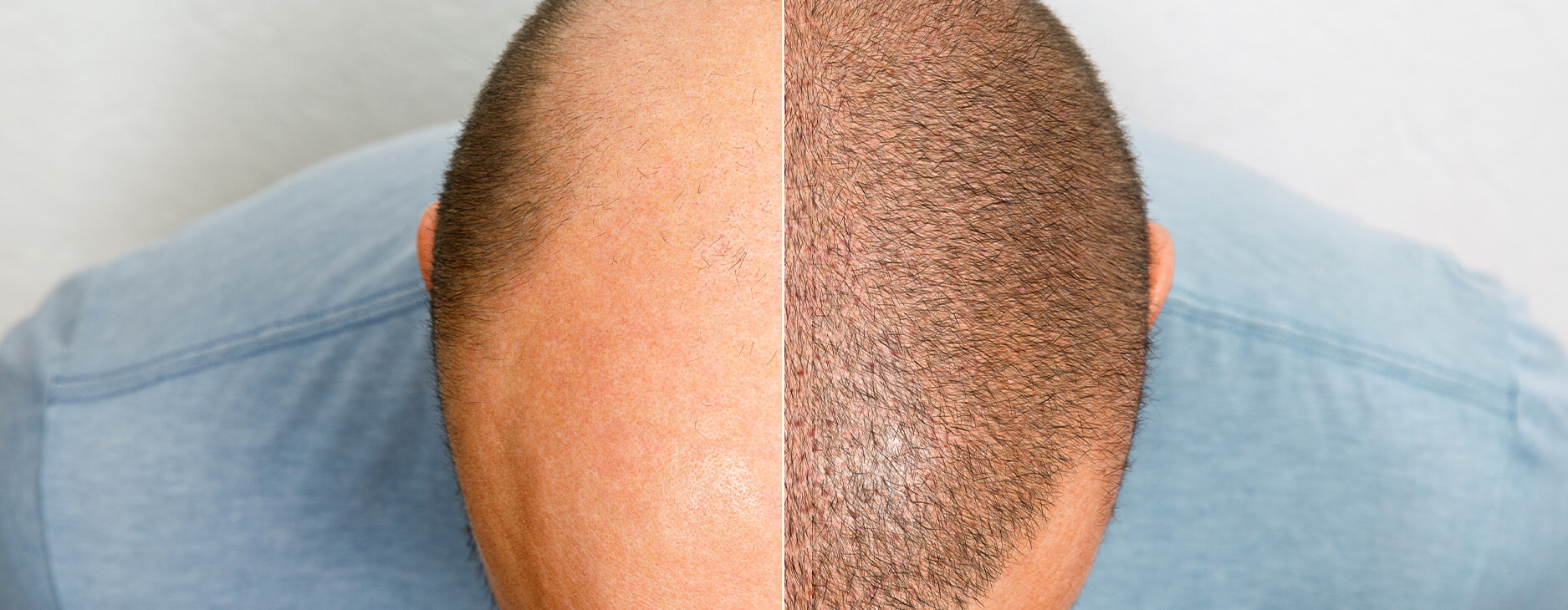 Before and After Hair Transplant with Pictures