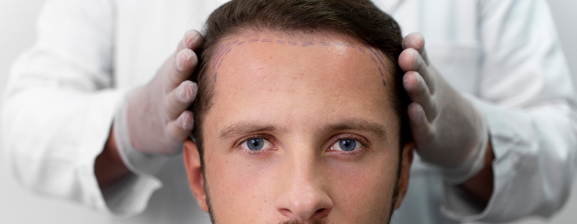 Is My Hairline Receding? Understanding the Signs and Treatment Options