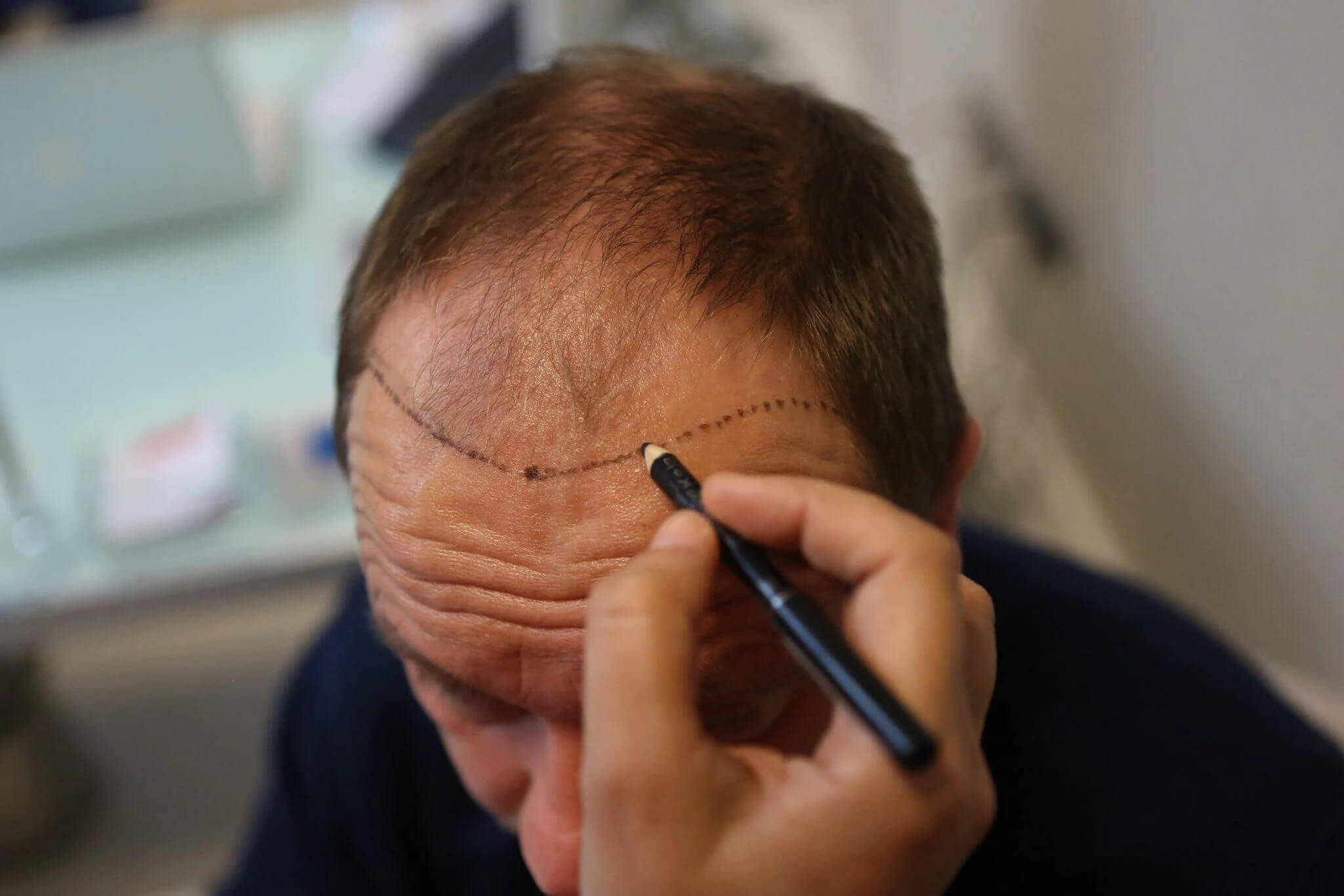 Hairline Design and Hair Clinic Calgary for Hair Transplants